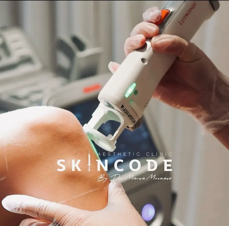 Pièce à main du laser Clarity II pendant une séance d’épilation au cabinet SKINCODE
