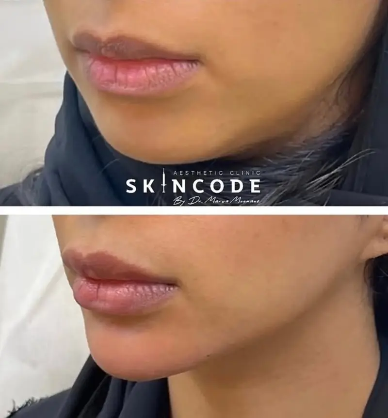 Lèvres, avant / après acide hyaluronique – cabinet SKINCODE, Casablanca