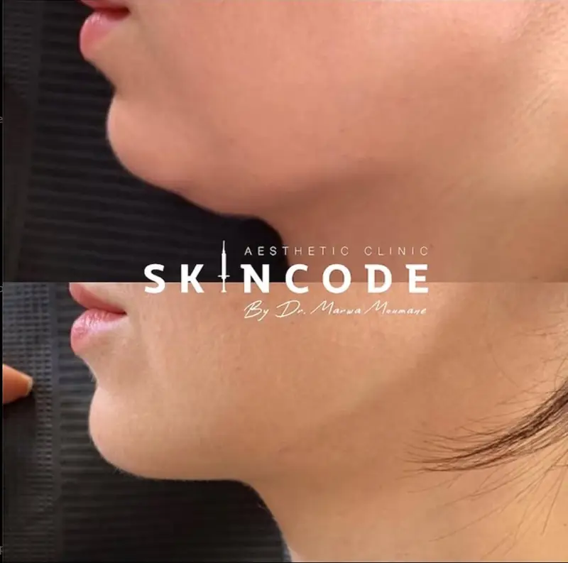 Menton, avant / après acide hyaluronique – cabinet SKINCODE, Casablanca