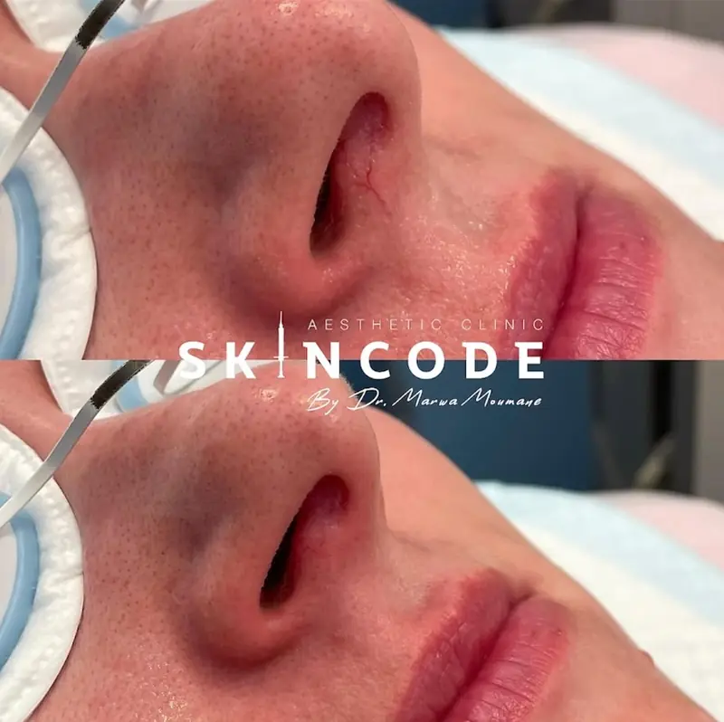 Soin du visage, avant / après – cabinet SKINCODE, Casablanca